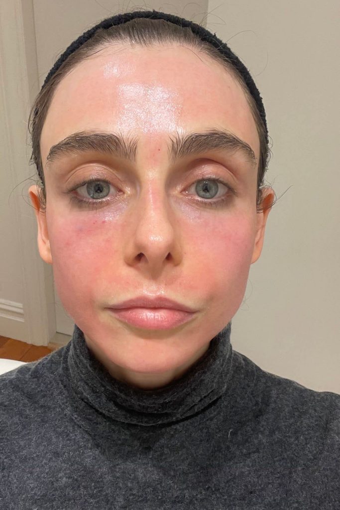 RF Microneedling Treatment downtime