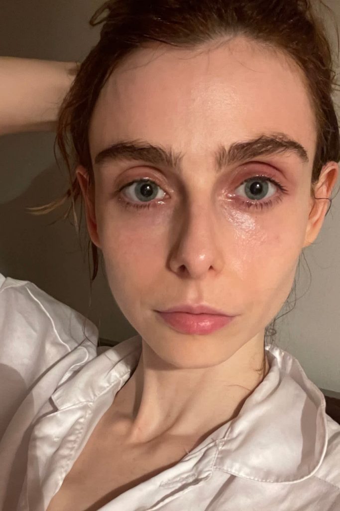 RF Microneedling before and after